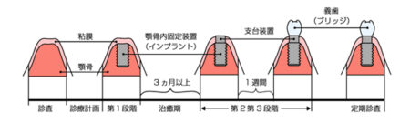 インプラントの治療期間