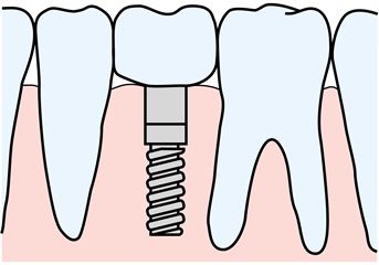 インプラントとは